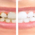 جرم گیری دندان چیست