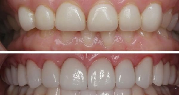 جراحی افزایش طول تاج دندان چگونه است