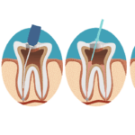 مراحل عصب کشی دندان
