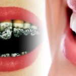 عوارض سیگار کشیدن بر دندانها یکی از صدها مشکلاتی است که برای سلامت بدن به وجود می آورد