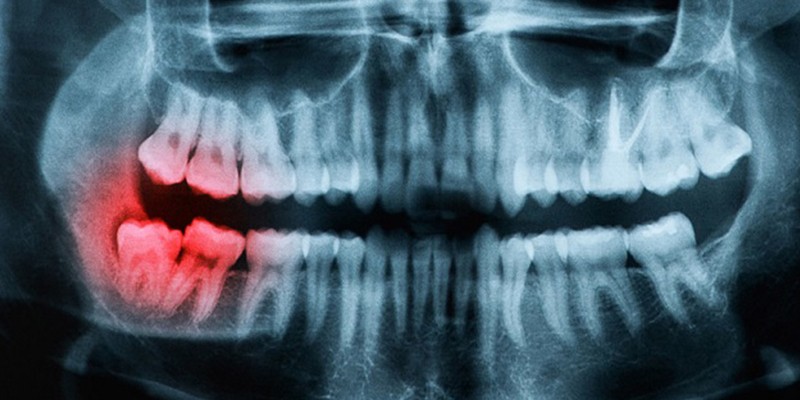 آسیبی که دندان عقل برای سایر دندان ها ایجاد میکند ؟