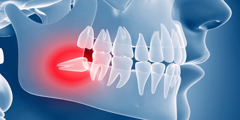 دندان عقل چه مشکلاتی را ایجاد میکند ؟