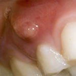 آبسه دندان به چه علتی ایجاد میشود ؟