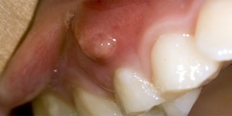 آبسه دندان به چه علتی ایجاد میشود ؟
