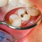 پوسیدگی دندان چگونه ایجاد میشود ؟