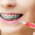 مسواک بین دندانی برای افراد دارای ارتودنسی مناسب است
