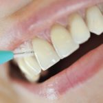 مسواک بین دندانی برای تمیز کردن پلاک های بین دندانی مهم است