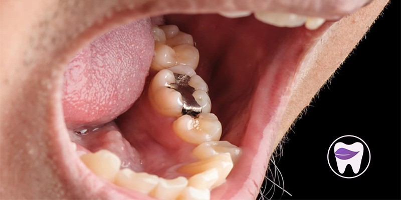 انواع آمالگام دندان کدام است و چه ویژگی دارد