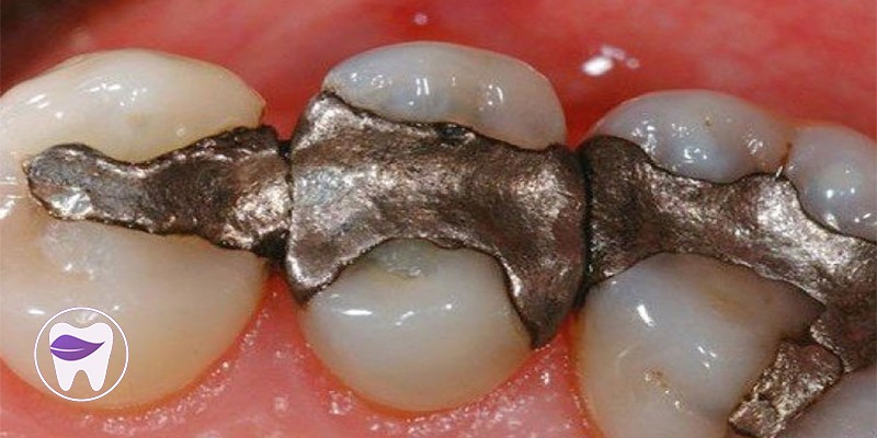 آیا انواع مختلف آمالگام دندان و کاربرد آن را میشناسید