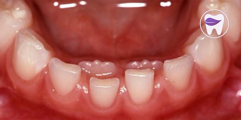 دندان اضافه کودکان را چگونه میتوان درمان کرد