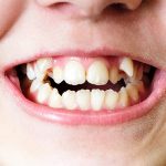 دندان اضافه کودکان چه مشکلاتی را میتواند ایجاد کند