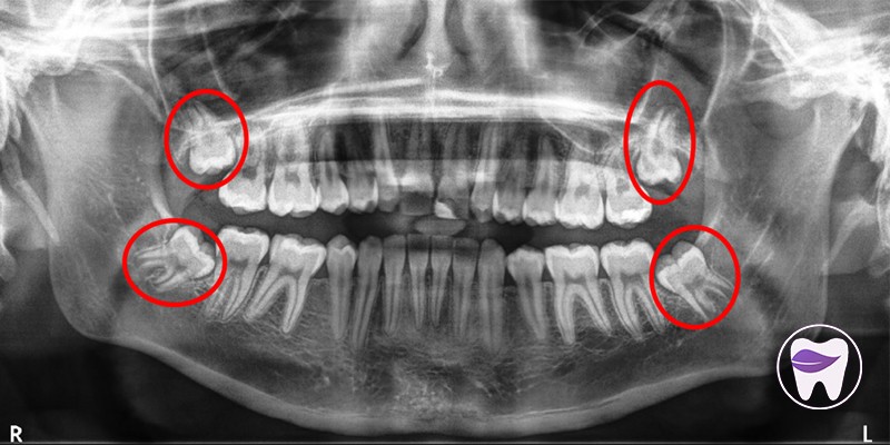 دندان عقل نهفته را چرا باید جراحی کرد ؟