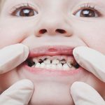 قطره آهن چه مشکلاتی را برای سلامتی دندان کودکان ایجاد میکند