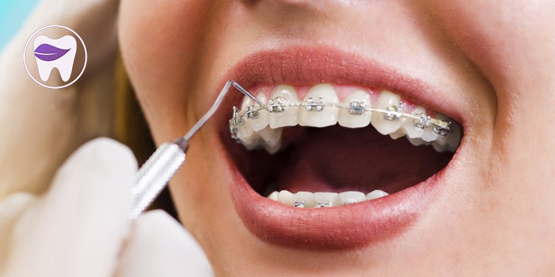 ارتودنسی دندان چیست و باعث ایجاد چه تغییراتی در دهان میشود ؟