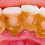 پلاک دندان چگونه ایجاد و راه های درمان آن چیست ؟