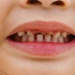 پوسیدگی دندان کودکان چه مشکلاتی را با خود به همراه دارد ؟