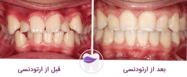 تغییراتی که قبل و بعد از ارتودنسی دندان ها صورت میگیرد
