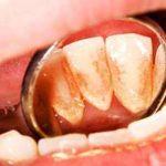 راه های درمان پلاک دندان چیست ؟