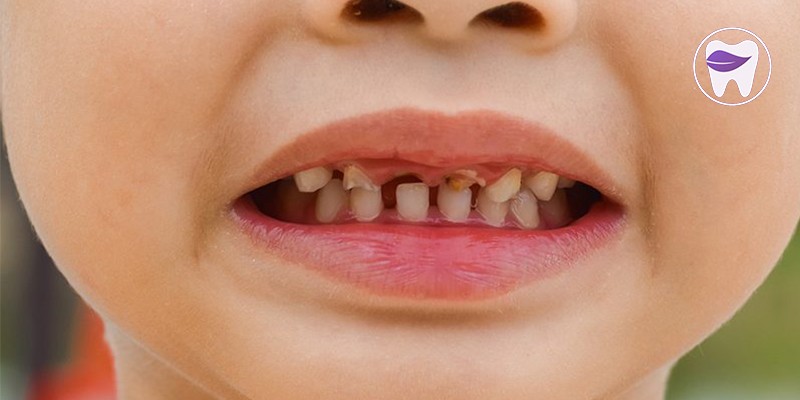 پوسیدگی دندان کودکان چه مشکلاتی را با خود به همراه دارد ؟