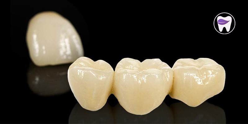 انواع مختلف تاج دندان کدام است