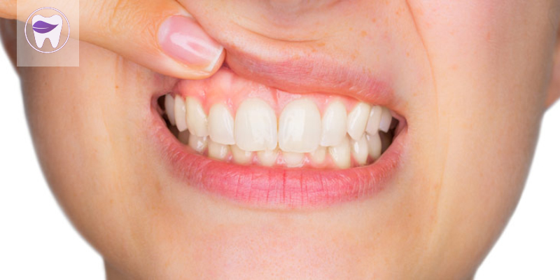 کیست دندان و خطراتی که برای سلامتی دندان ها دارد