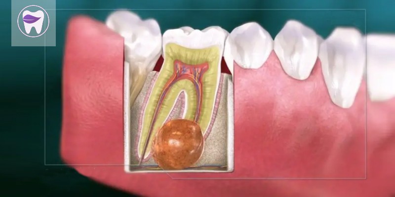 کیست دندان چیست و چه خطراتی که برای سلامتی دندان ها دارد