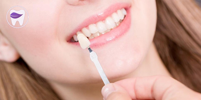 برای مراقبت از لمینت دندان چه نکاتی را لازم است که بدانیم ؟
