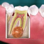 کیست دندان چیست و چه خطراتی که برای سلامتی دندان ها دارد