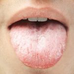 خشکی دهان چه نشانه ها و علایمی دارد ؟