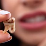 پوسیدگی دندان در بارداری به چه علتی صورت میگیرد