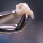 کشیدن دندان چه زمانی الزامی است و چه نکاتی باید بدانیم