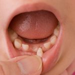 آیا لق شدن دندان کودکان را جدی بگیریم