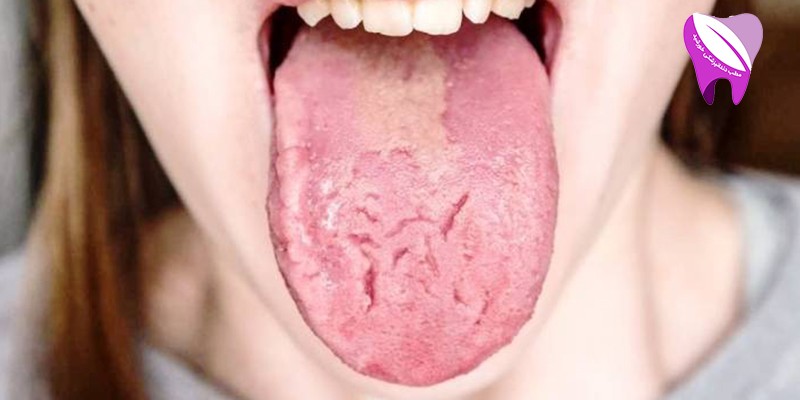 ترک خوردن زبان چه علت و درمانی دارد ؟