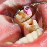 درمان ریشه دندان چگونه صورت میگیرد