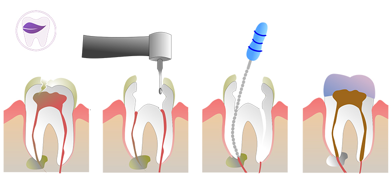 مراحل درمان ریشه دندان چگونه صورت میگیرد