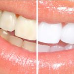 درمان لک و تغییر رنگ دندان