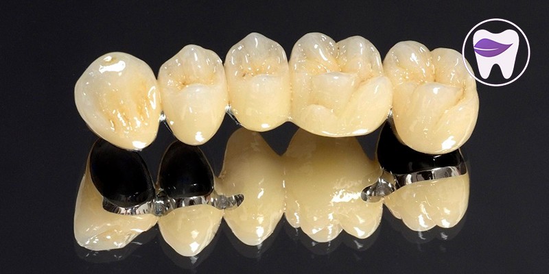 روکش PFM برای چه دندان هایی مناسب است ؟