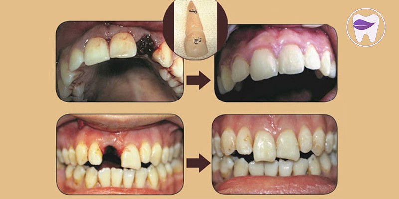 کدام دندانها بیشتر دچار ترومای دندان می شوند؟