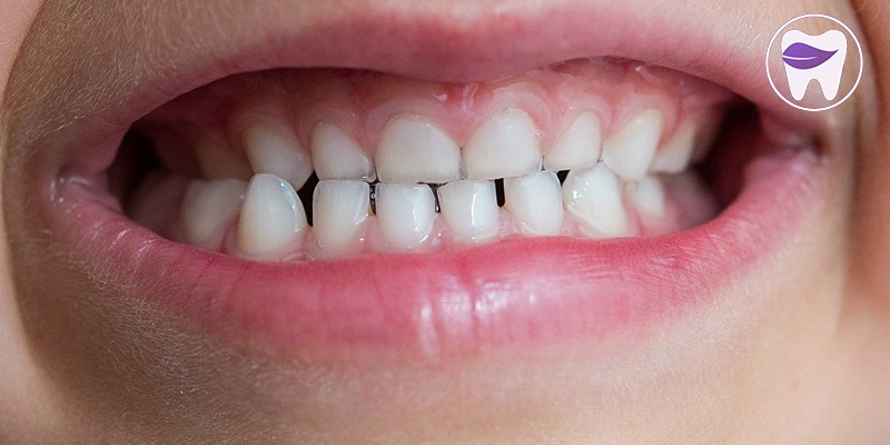 کراس بایت دندان چگونه درمان میشود ؟