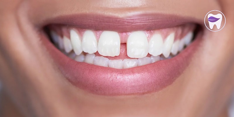 دیاستما ( فاصله بین دندانی ) چه درمانی دارد ؟