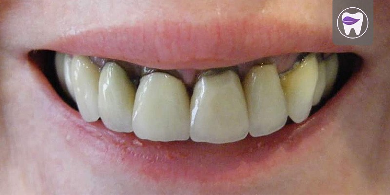 عفونت دندان روکش شده ، نشانه ها تا درمان آن