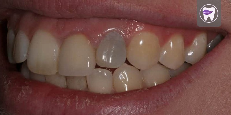 از عفونت دندان روکش شده چه اطلاعاتی دارید ؟