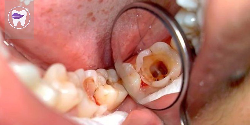 عوامل مؤثر در نکروز دندان چیست ؟