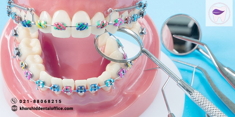 مراقبت از ارتودنسی دندان و نکات مهمی که باید بدانید