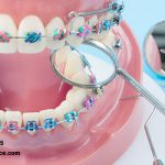 مراقبت از ارتودنسی دندان و نکات مهمی که باید بدانید