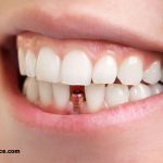 مراقبت از ایمپلنت دندان چه نکاتی دارد ؟