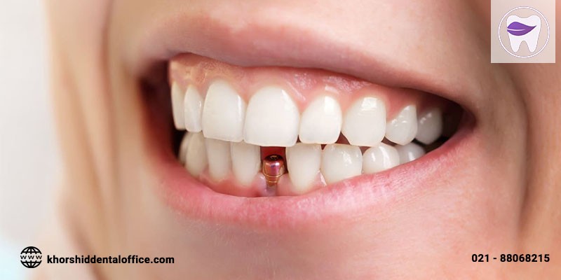 مراقبت از ایمپلنت دندان چه نکاتی دارد ؟