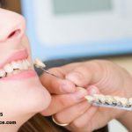 مراقبت از لمینت دندان چه نکاتی دارد ؟