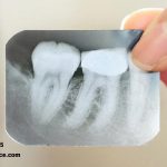 نکات طلایی برای مراقبت بعد از عصب کشی دندان
