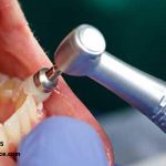 نکات مهم در مراقبت بعد از جرمگیری دندان